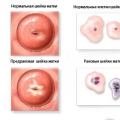 Рак шейки матки: лечение рака шейки матки