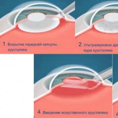 Методы восстановления зрения при близорукости