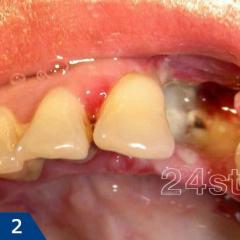 Альвеолит лунки, сухая лунка после удаления зуба – как лечить