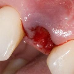 Alvéolite après extraction dentaire - symptômes, traitement et prévention