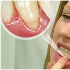 Как да предотвратим възпаление на венците