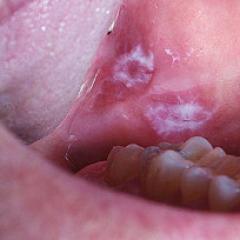 Съвети за проверка на бели петна по устната лигавица