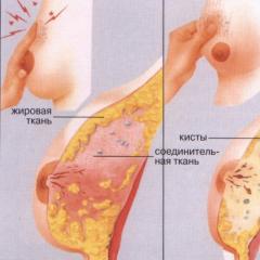 Признаци и симптоми на мастопатия на млечната жлеза - диагностика, лечение с лекарства и народни средства