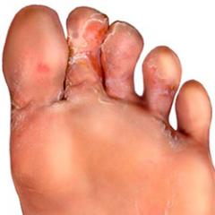 مرهم ضد الفطر على الساقين بين الأصابع ، وهو الأكثر فعالية؟