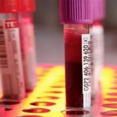 AST en analyse sanguine biochimique : norme et pathologie