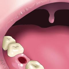 كيفية علاج التهاب سمحاق الأسنان