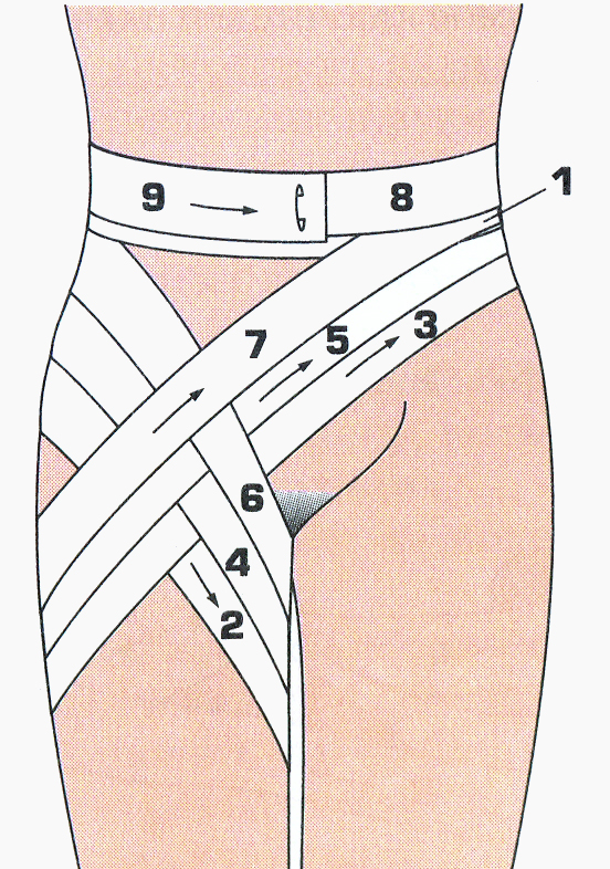 Перев з. Паховая колосовидная повязка. Колосовидная повязка на бедро. Техника наложения колосовидной повязки на бедро. Колосовидная повязка на бедренный сустав.