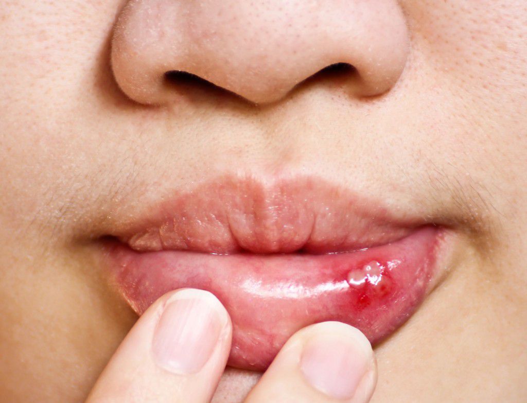 Как бързо да се отървете от раните в устата