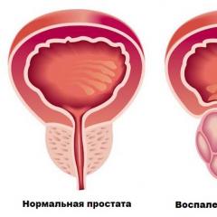 انواع اصلی پروستاتیت فرم خفیف پروستاتیت