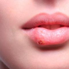Combien de jours passe l'herpès sur les lèvres?