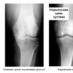 Ефективно лечение на артроза на колянната става у дома: народни средства и препарати Домашно лечение на артроза на колянната става