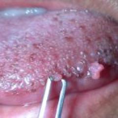Лечение на папиломи в езика, венците и устата