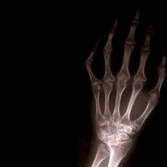 Симптоми и лечение на деформиране на артрозата на малките стави на ръцете